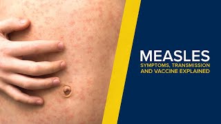 Measles - Symptoms, Transmission and Treatment Explained By a Doctor