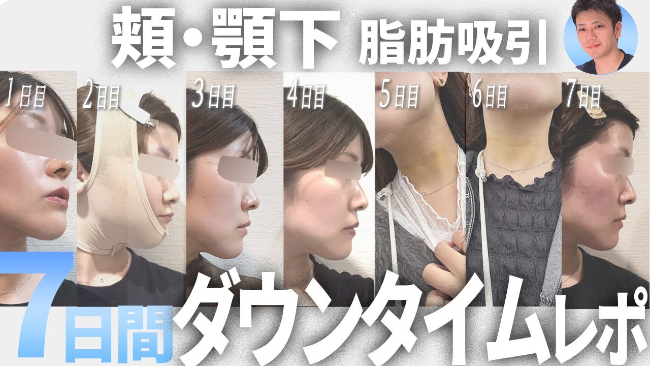 【頬・顎下の脂肪吸引】吸引後のリアルな一週間を徹底レポ！【ダウンタイムレポ】