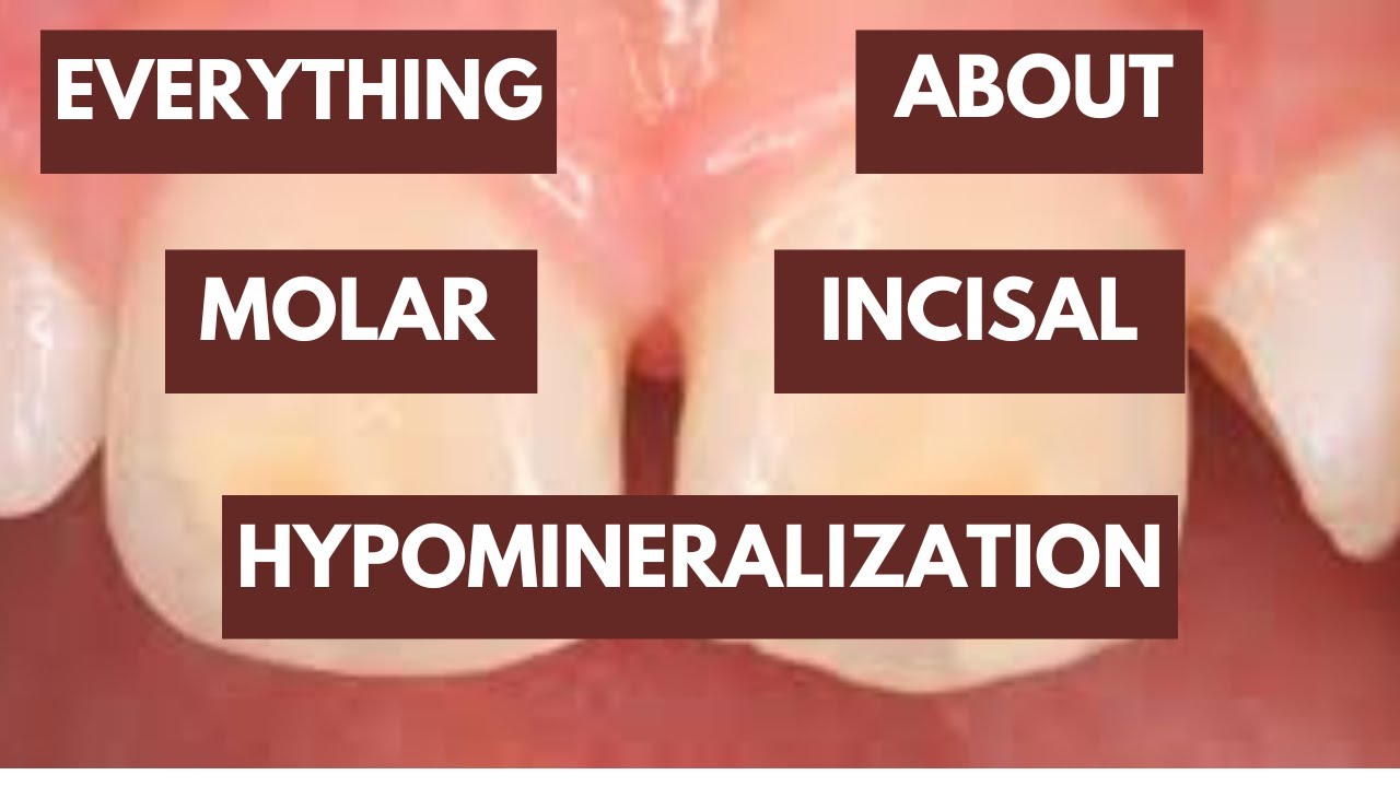 Molar Incisor Hypomineralization Introduction, Etiology, Clinical