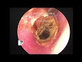 Endoscopic ear treatments by Dr Zhao EP.40- 09/07/2020