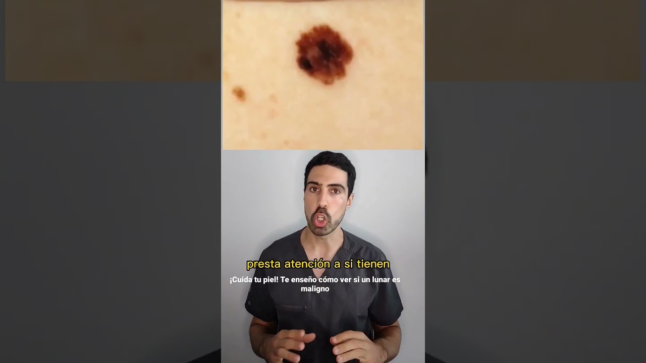DERMATÓLOGO explica CÓMO detectar el MELANOMA. Evita el CANCER DE PIEL! Revisa tus lunares
