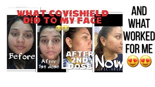 Pimples after vaccination | Covishield side effects| #covishieldvaccine #covishield #covisheild