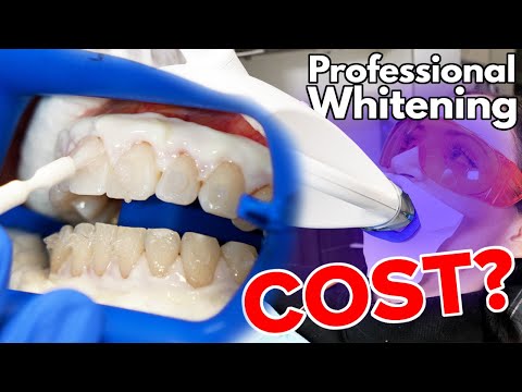 वीडियो: पेशेवर दांत कितने सफेद करते हैं?