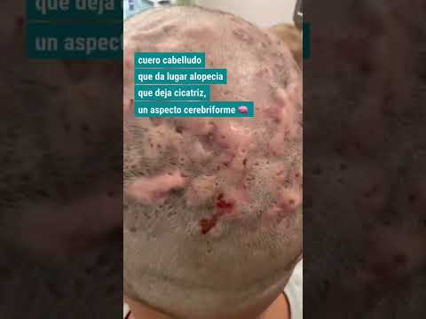 Video: ¿Cómo tratar la celulitis disecante del cuero cabelludo?