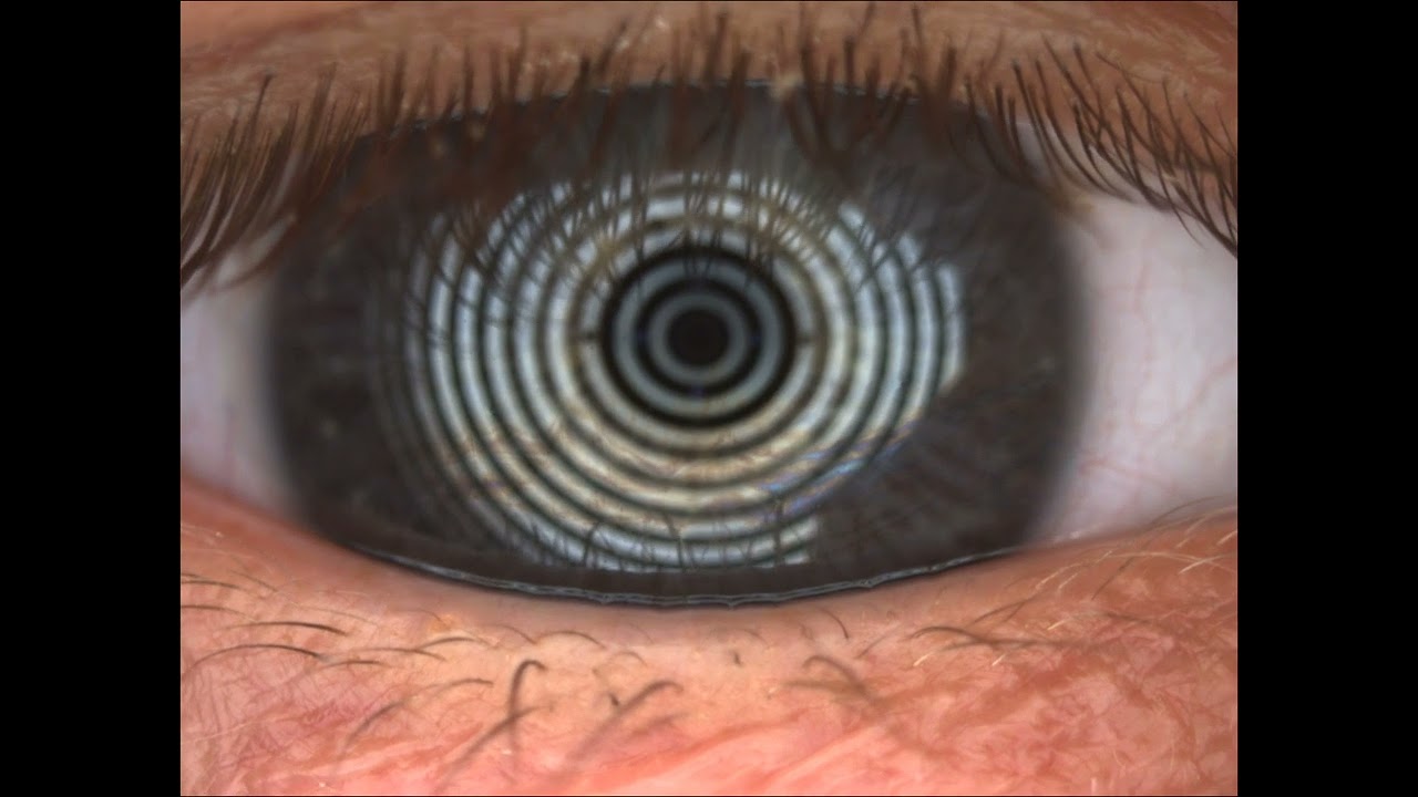Good lipid layer using infrared interferometry | The Dry Eye Clinic Scotland at Peter Ivins Eye Care