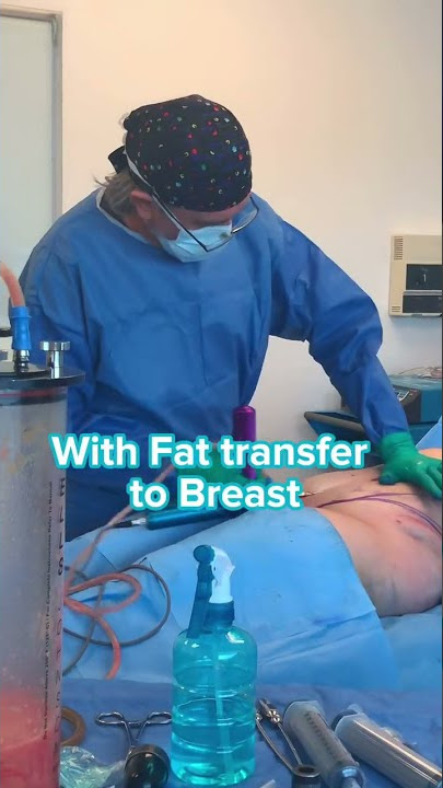 Lipo 360º   Fat transfer to breast by Dr.Bucio #plasticsurgery #lipo360 #tijuana #sandiego #lipo
