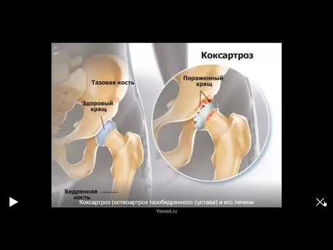 100% Лечение коксартроза