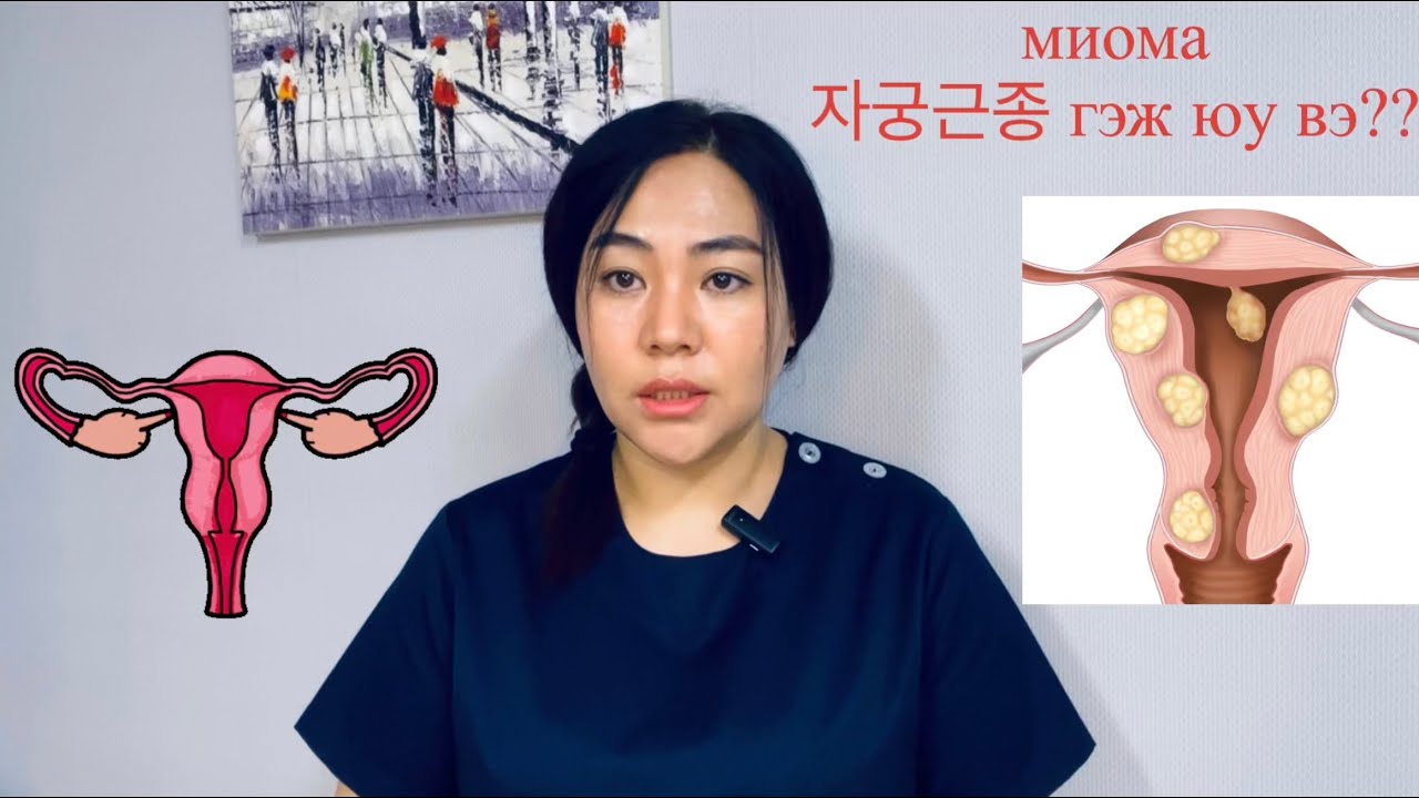 Миома гэж юу вэ?  Миомыг яагаад эмч нар тоодоггүй вэ?