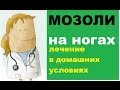 Мозоли на ногах: лечение в домашних условиях