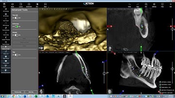 Virtual Endoscope in Acteon AIS 5.0 Software