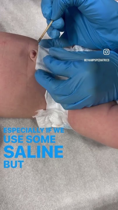 Treating An Umbilical Granuloma With Silver Nitrate YouTube treating-an-umbilical-granuloma-with-silver-nitrate-youtube
