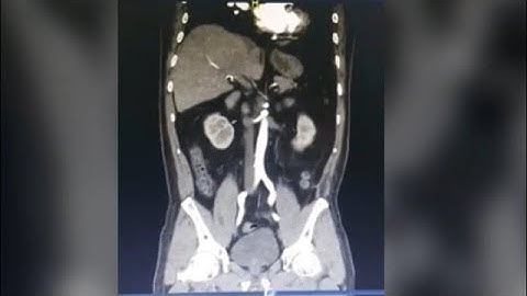 GIST Radiology ll Gastro Intestinal Stromal Tumour