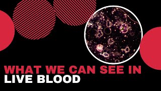 Looking Through The Lens Severe Parasite Infection