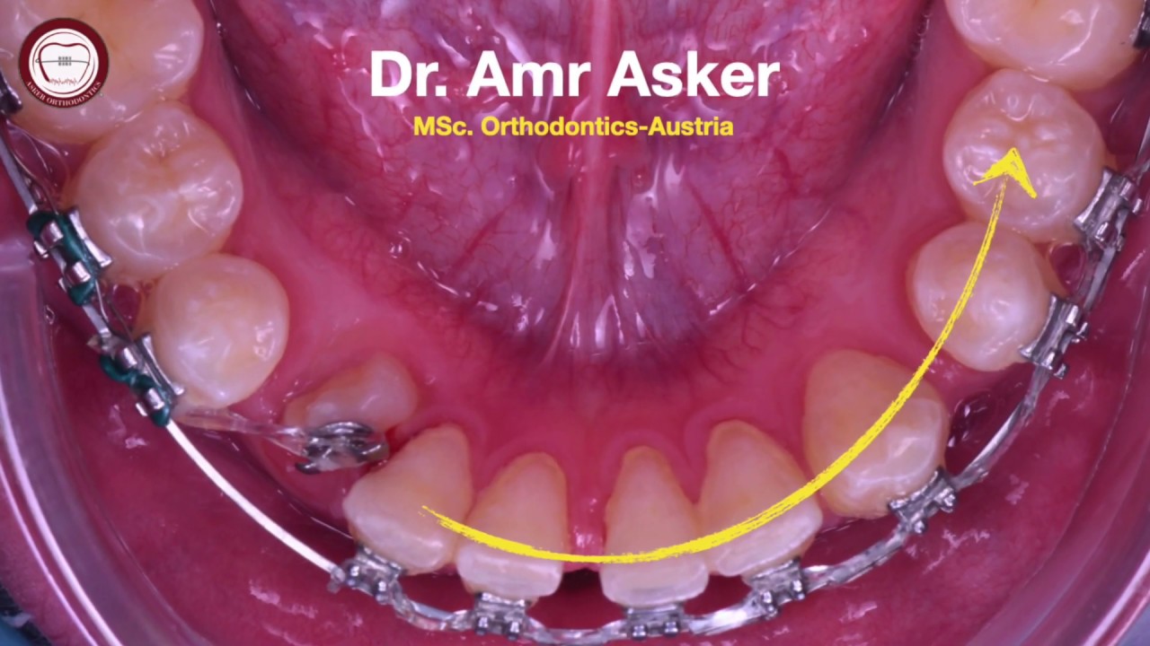 Step by step orthodontic archwire insertion for rotated canine traction