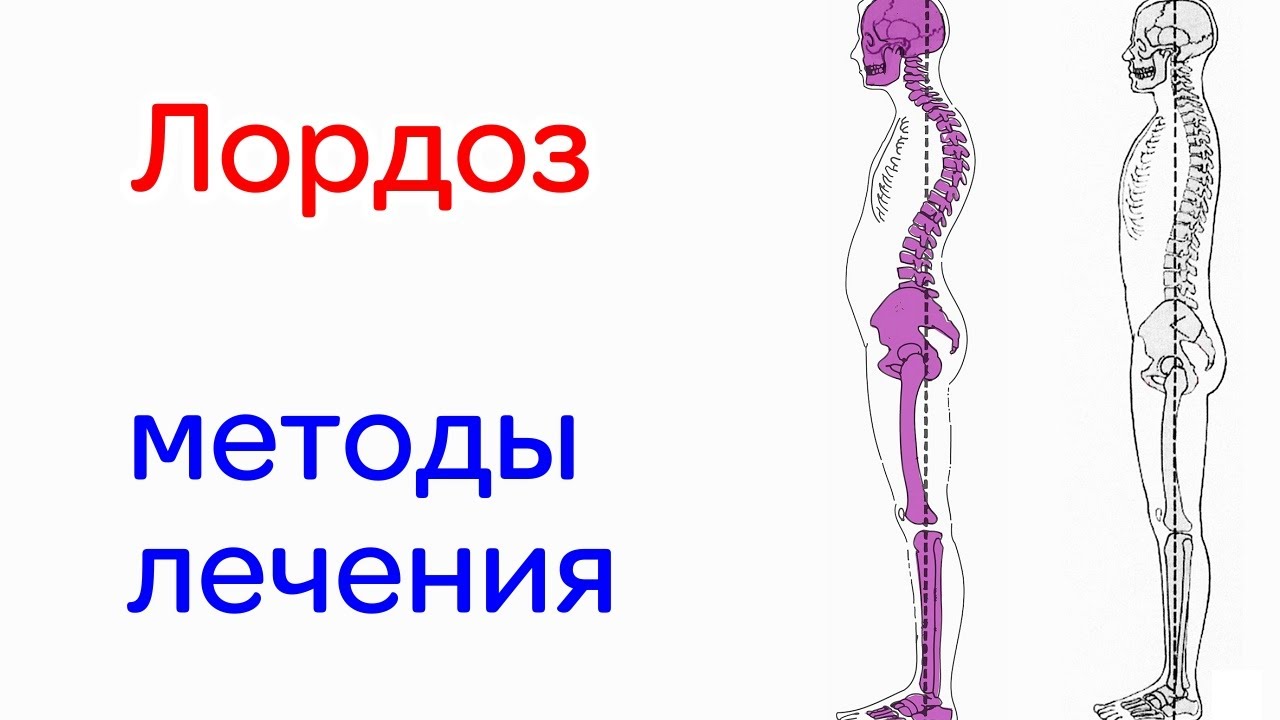 Лордоз симптомы, диагностика, лечение, прогноз и профилактика - YouTube