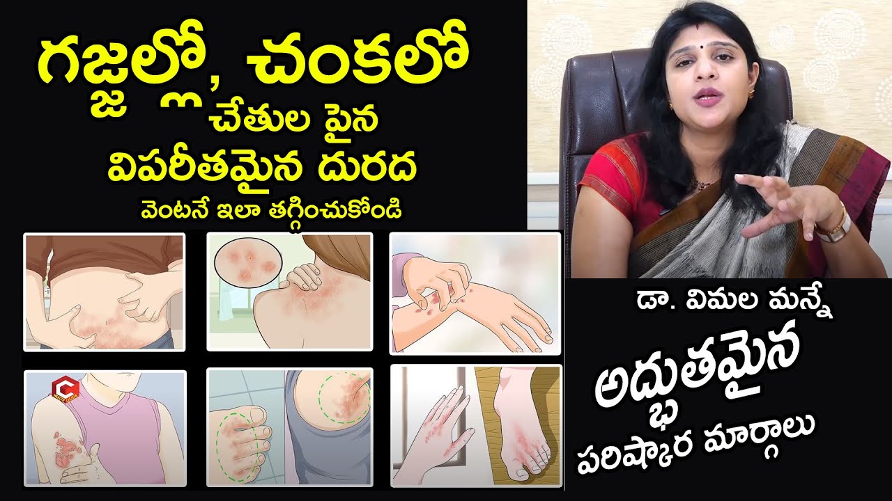 గజ్జల్లో, చంకలో, చేతుల పైన విపరీతమైన దురద..! | How To Get Rid Of Fungal Infections | Dr. Vimala | HQ
