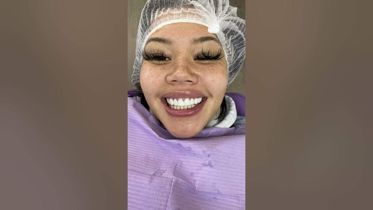 2500 veneers cancun