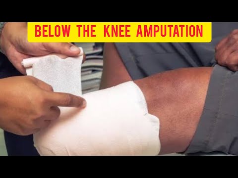 Below the knee amputation surgery