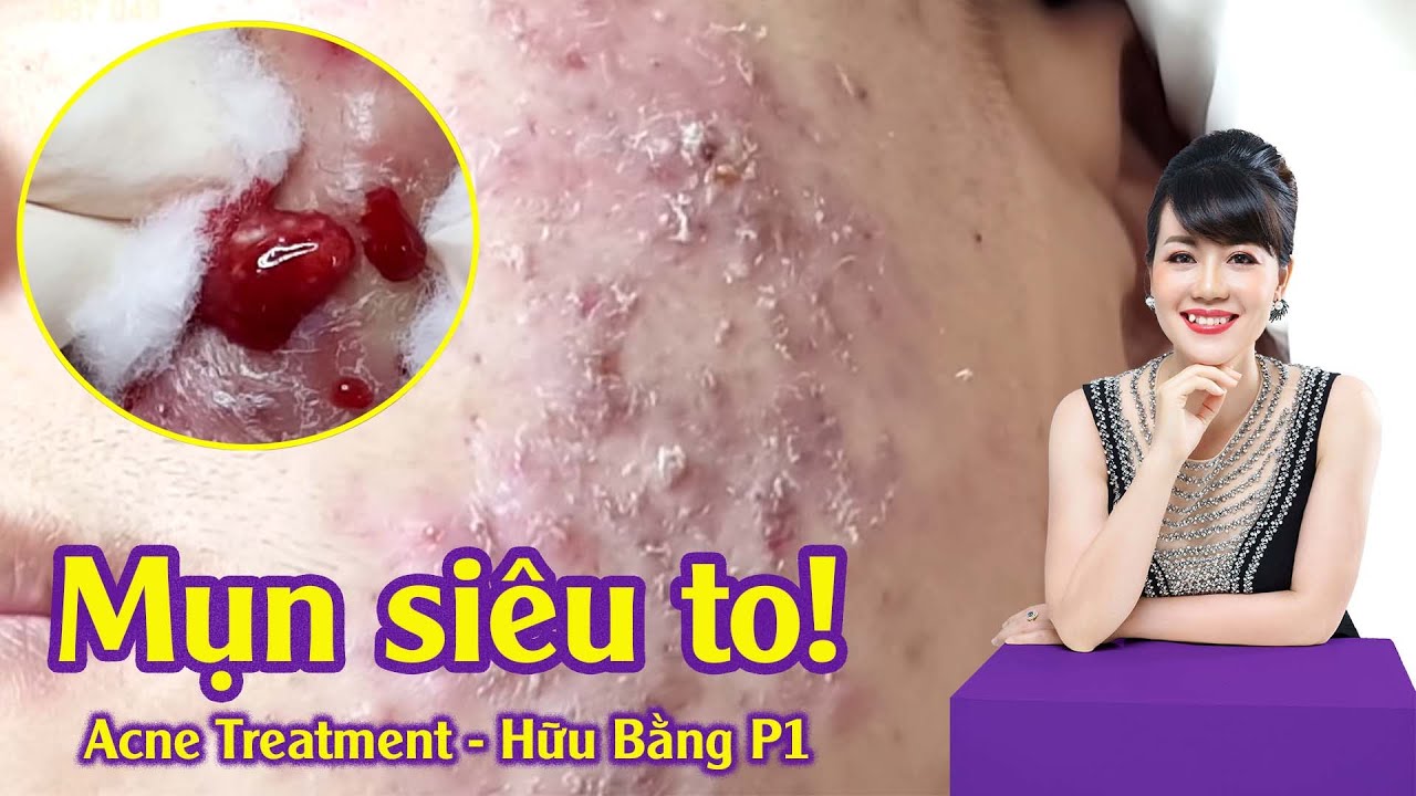 Điều trị mụn viêm nang do dùng thuốc rượu lột tẩy| Hiền Vân spa |Phạm Hữu Bằng| Part 1 | 584