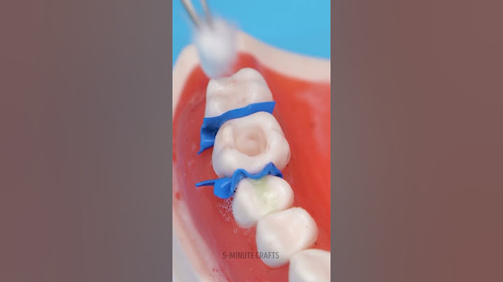 What Removing a Cavity Looks Like Through a Doctor’s Eyes! 🦷👀✨