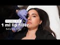 I GOT LIP FILLERS FOR THE FIRST TIME! - 1ML