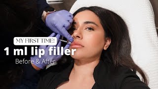 I GOT LIP FILLERS FOR THE FIRST TIME! - 1ML screenshot 4