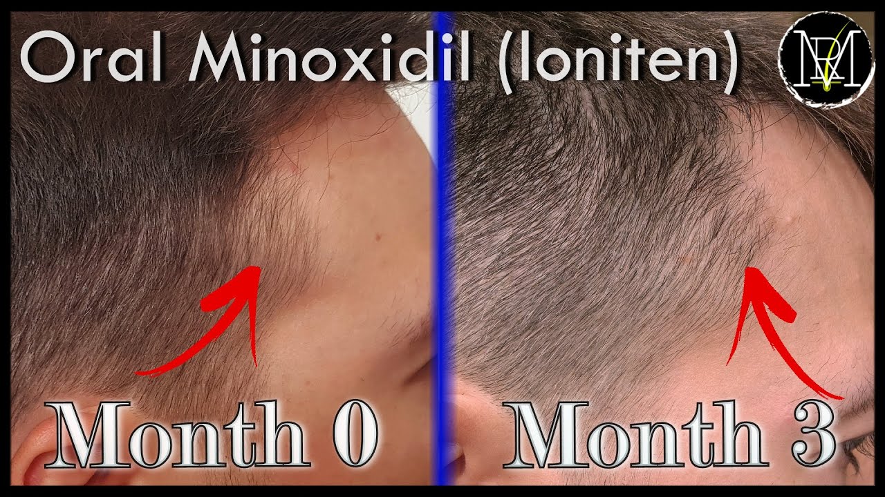 Justering sekvens midt i intetsteds Oral Minoxidil (Loniten) Result in 3 months - YouTube