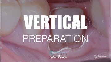 TT Vertical Preparation Full Protocol