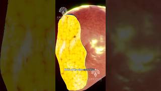How Your Liver Regrow After Donation 😮 #short #liverregeneration - Creativelearning3d
