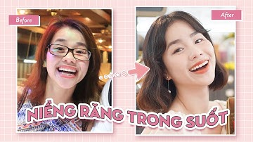 Review Trải Nghiệm Niềng Răng Trong Suốt Invisalign ♡ Quin