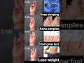 Powerful Mudras #deep #sleeping #acne #pimple #hair #grow #fast #lose #weight