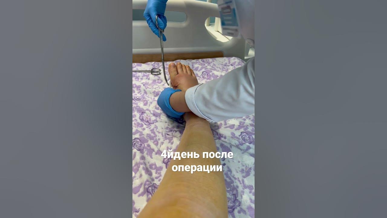 4й день после операции хальгус вальгус . алматы - YouTube
