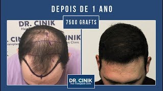Dr Cinik Clínica De Transplante Capilar Hair Transplant Dr Emrah Cinik