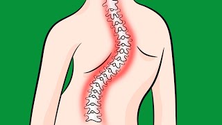 How to Fix Idiopathic Scoliosis Naturally Resimi