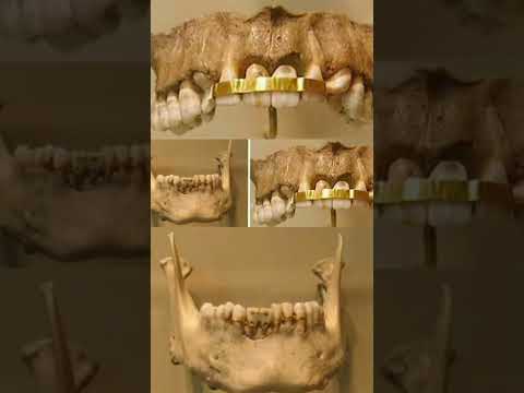اقدم تقويم اسنان مصري قديم 