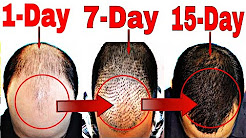 How to Stop Hair Fall Naturally | Grow Hair Faster(Men & Women), How to Stop Hair Fall Naturally | Grow Hair Faster(Men & Women), How to Stop Hair Fall Naturally | Grow Hair Faster(Men & Women), How to Stop Hair Fall Naturally | Grow Hair Faster(Men & Women)
