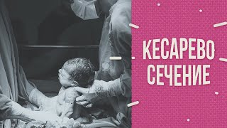 Кесарево сечение Кесарево сечение