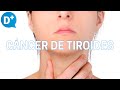 Cáncer de tiroides: Qué es, por qué se produce y cómo se trata