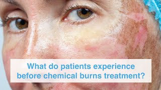 What do patients experience before chemical burns treatment? Resimi