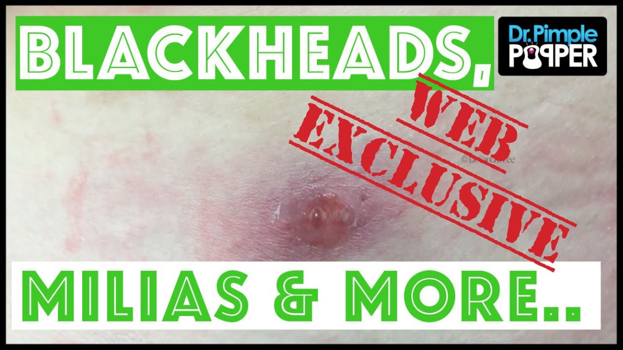 WEB EXCLUSIVE SNEAK PEEK Blackheads, Milia, Inflamed Cyst & MORE