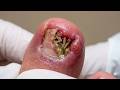 Wow, Super Thick Onychomycosis Requires Careful Trimming! #toenails  #2