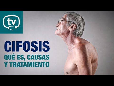 Vídeo: Cifosis: Curvatura De La Parte Superior De La Columna Vertebral Una Vez Llamada Joroba Viuda