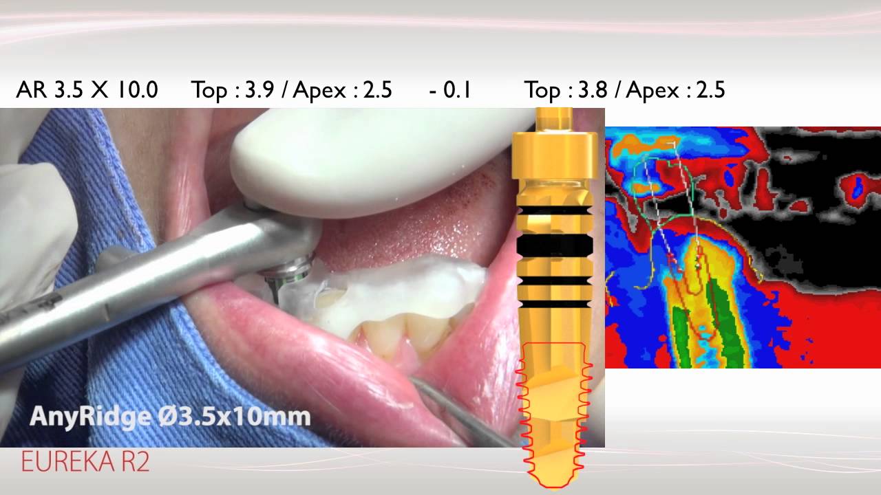 Установка ФДМ ANYRIDGE. Имплантологияесктй нвблр any Ridge. Hard bone