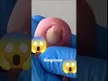 #toenails #ingrown