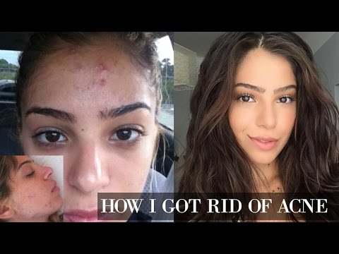 Video: The Presence Of Acne Is Associated With A Psychological State - Alternative View