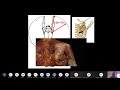 PRÓTESE REVERSA - ASPECTOS CONCEITUAIS E RADIOLÓGICOS - AULA DADA PARA RADIOLOGISTAS DO GRUPO DASA