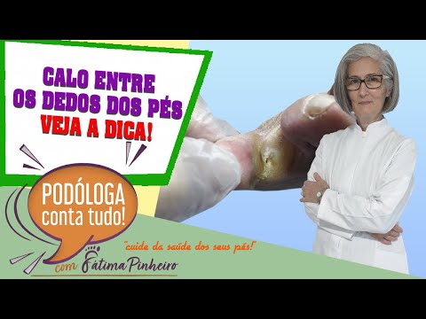 CALO ENTRE OS DEDOS DOS PÉS - VEJA A DICA!