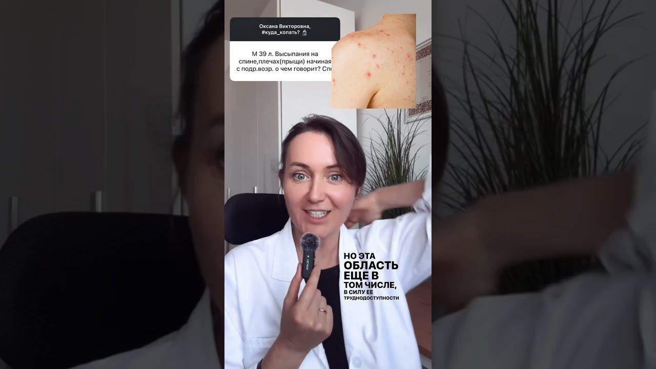 ПРЫЩИ на спине: ЛЕГКО убрать если…