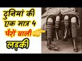 दुनिया की एकमात्र चार पैरों वाली लड़की😱 | The only girl with four legs in the world #shorts