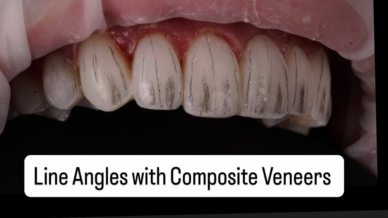 LINE ANGLES with Composite Veneers 